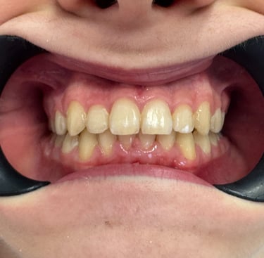 Proste zęby po leczeniu ortodontycznym
