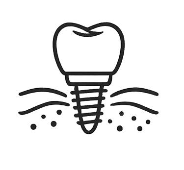 Implante dental con integración ósea y planificación avanzada