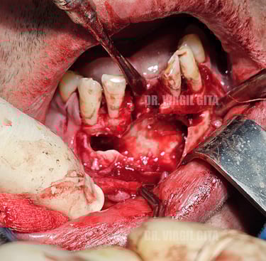 Chistectomie Mandibulara