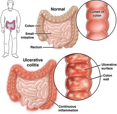Colitis GASTRO FOUNDATION