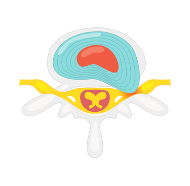 disque-hernie-osteopathe