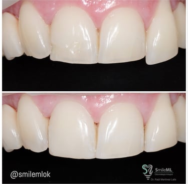 a close up of a smile with a toothbrush