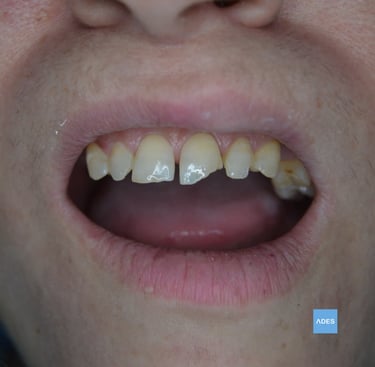 fractura dental