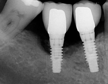 Image radiographique d'implants dentaires