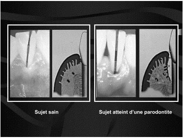 parodontie hygiene-precision jet dentaire ozone Aquolab