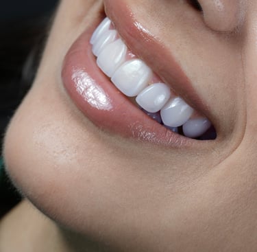 Dental Veneers is a part of Smile Makeover Treatment