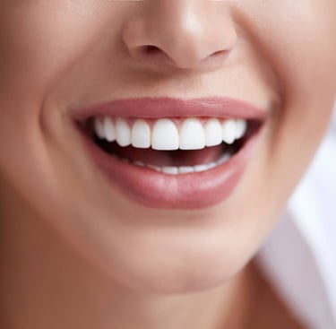Dental Veeners Smile Design