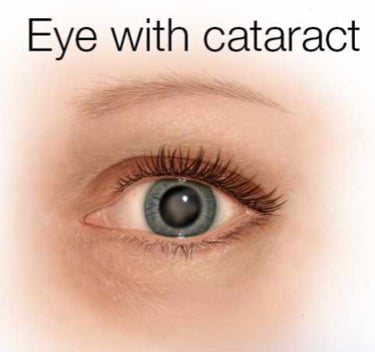Image of human eye with cloudy cataract in lens.