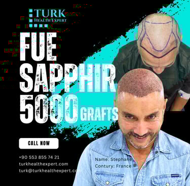 before & after hair transplant 5000 grafts