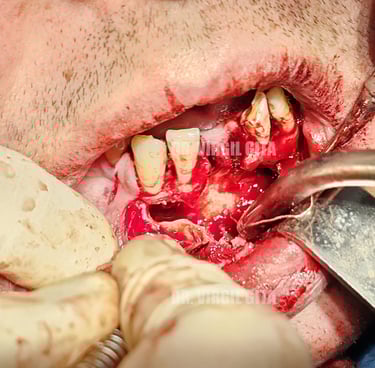 Chistectomie mandibulara