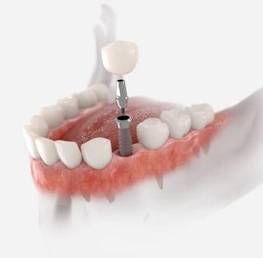 Inserare implant dentar