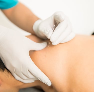 dry needling