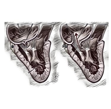 Mitral Valve Repair  Dr. Anbarasu Mohanraj