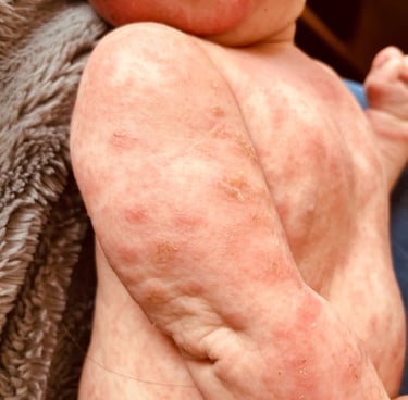 Eczéma présent sur tout le corps d'un bébé avec de grandes plaques