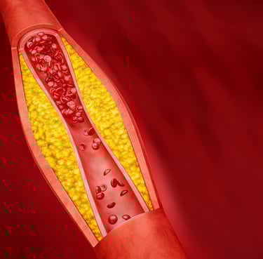Representação esquemática de placas de gordura obstruindo as artérias do coração