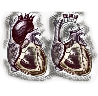 Aortic Aneurysm & Aortic Dissection Dr. Anbarasu Mohanraj