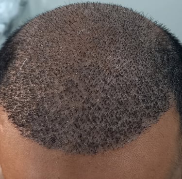 Hair transplant, hair fall, hair regrowth, hair transplant surgeon, hair transplant in peshawar