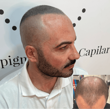 Micropigmentación para disimular calvicie