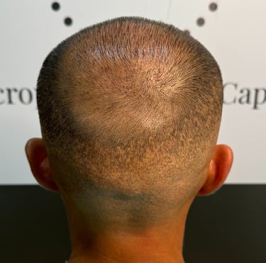 #RecuperaTuZonaDonante #MicropigmentaciónCapilar #ReparaciónZonaDonante #SoluciónCapilar #Reparación