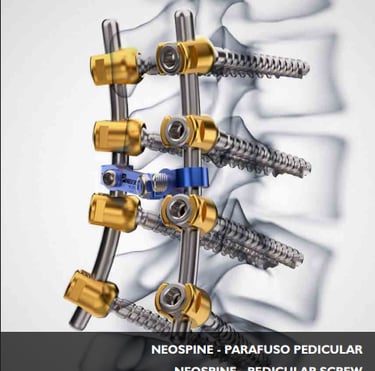 Neospine pedicular screw system for spinal stabilization surgery on human vertebrae.