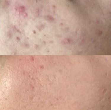 Skin transformation results showing improvement in acne after tailored treatment plan