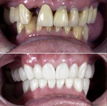 smile makeover with porcelain crowns