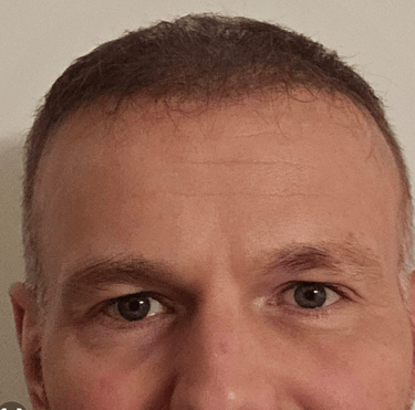 a man after his anti wrinkle injections treatment