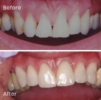 before and after picture of gum grafting