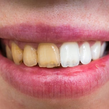 teeth cleaning near me