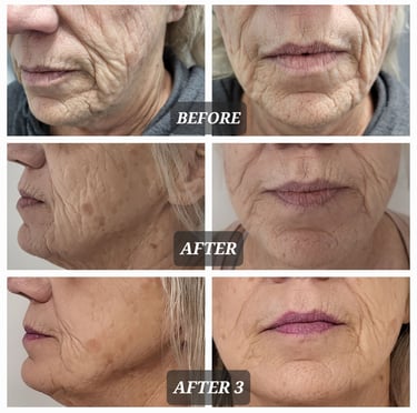 RF Microneedling coparison of facial skin rejuvenation showing reduced wrinkles and fine lines.