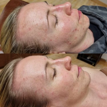 Before and after acne treatment results achieved through personalised acne specialist UK care
