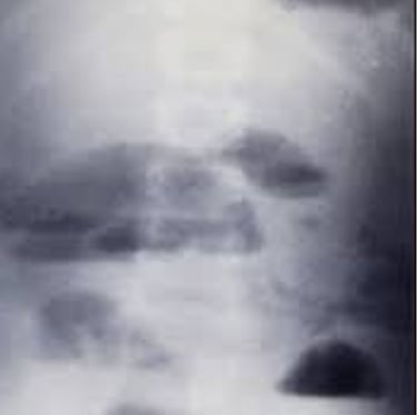 Emesis and Upper Digestive Tract Blockages