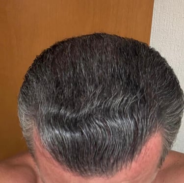 Resultado final con 6 meses utilizando AUREVIA™