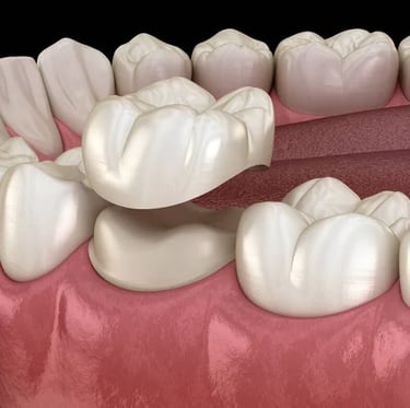 implante dentário