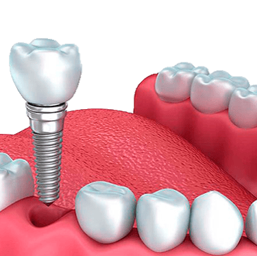 implante dentário
