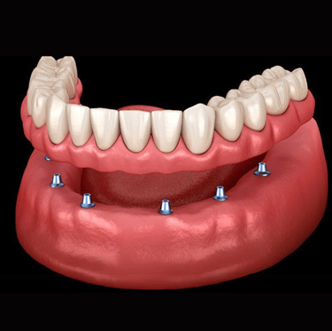implante dentário