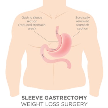 diagram of sleeve gastrectomy with the stomach split into a thin sleeve section and a removed area