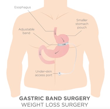 illustration of gastric band