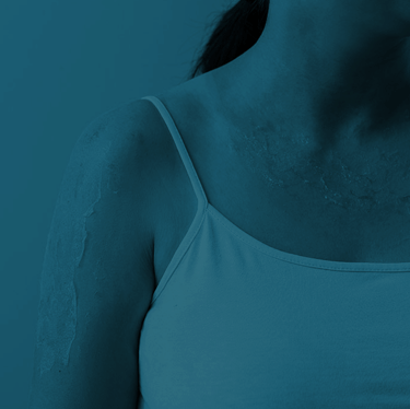 Tratamento de Queimaduras