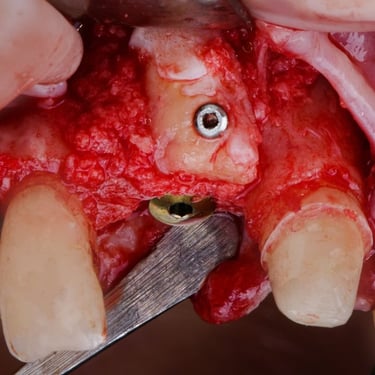 bone graft