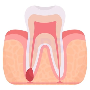 dental cyst