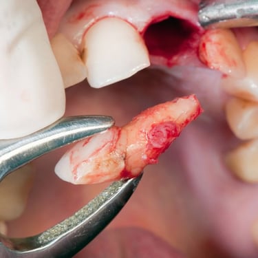 extraction teeth