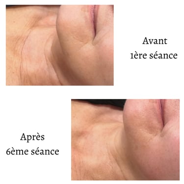 Endospheres Therapy Cou