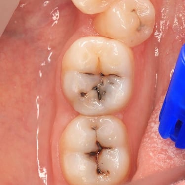 "how to make white teeth OralSurgery root canal price in mumbai WisdomTeeth"