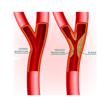 vascular ultrasound artery atherosclerosis stenosis disease stent carotid doppler stroke tia vision dizziness headache plaque