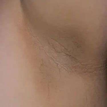 Escurecimentos das axilas doença Acantose Nigricans