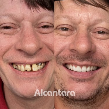 Antes e depois de implantes dentários em homem na clínica Alcantara Odontologia, Maringá.