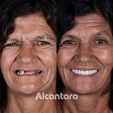 Antes e depois de prótese sobre implantes em mulher na Alcantara Odontologia, Maringá.