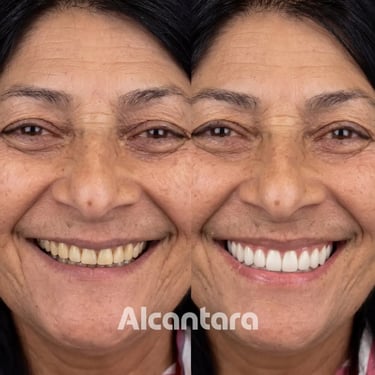 Antes e depois de estética dental feminina na clínica Alcantara Odontologia em Maringá.