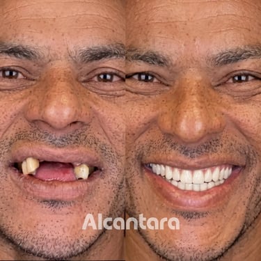 Antes e depois de prótese fixa dentária masculina na Alcantara Odontologia em Maringá.
